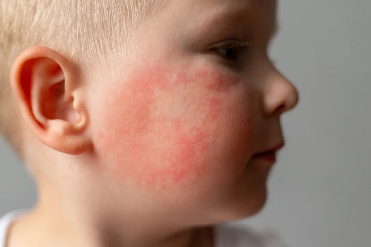 rumień zakaźny dziecko policzki wysypka