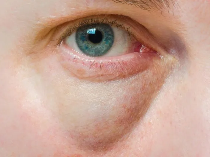 Obrzęki twarzy i powiek przy chorobach nerek