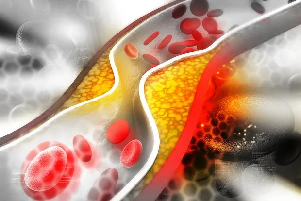 Zdjęcie Podwyższony poziom LDL: jak skutecznie obniżyć zły cholesterol we krwi