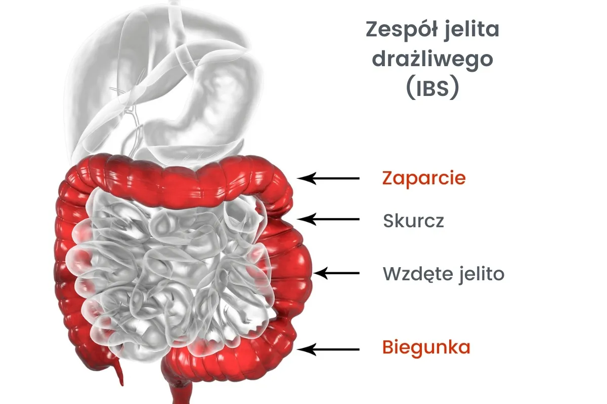Zespół Jelita Drażliwego (IBS) objawy