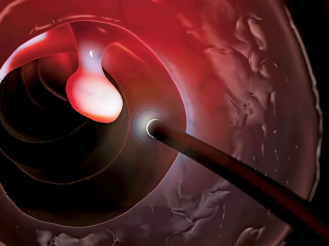 Polipy jelita grubego ilustracja