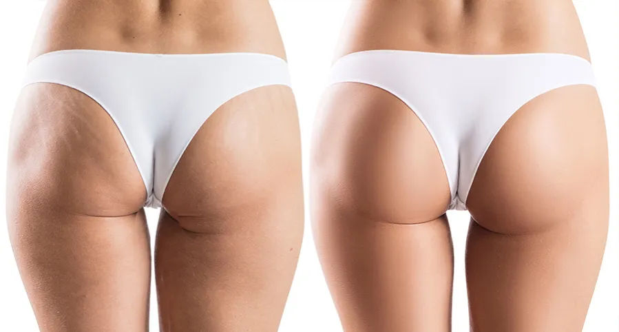 r&oacute;żne metody liposukcji por&oacute;wnanie