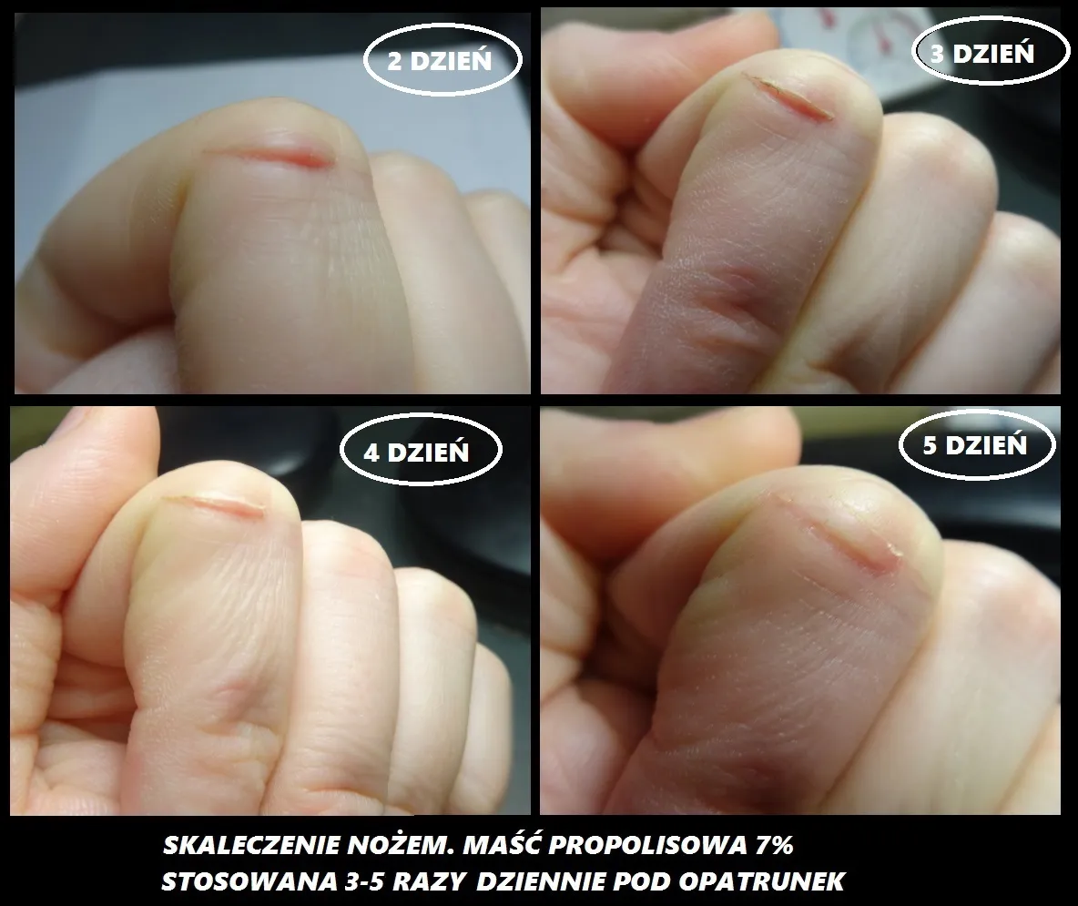 propolis na skórę rany