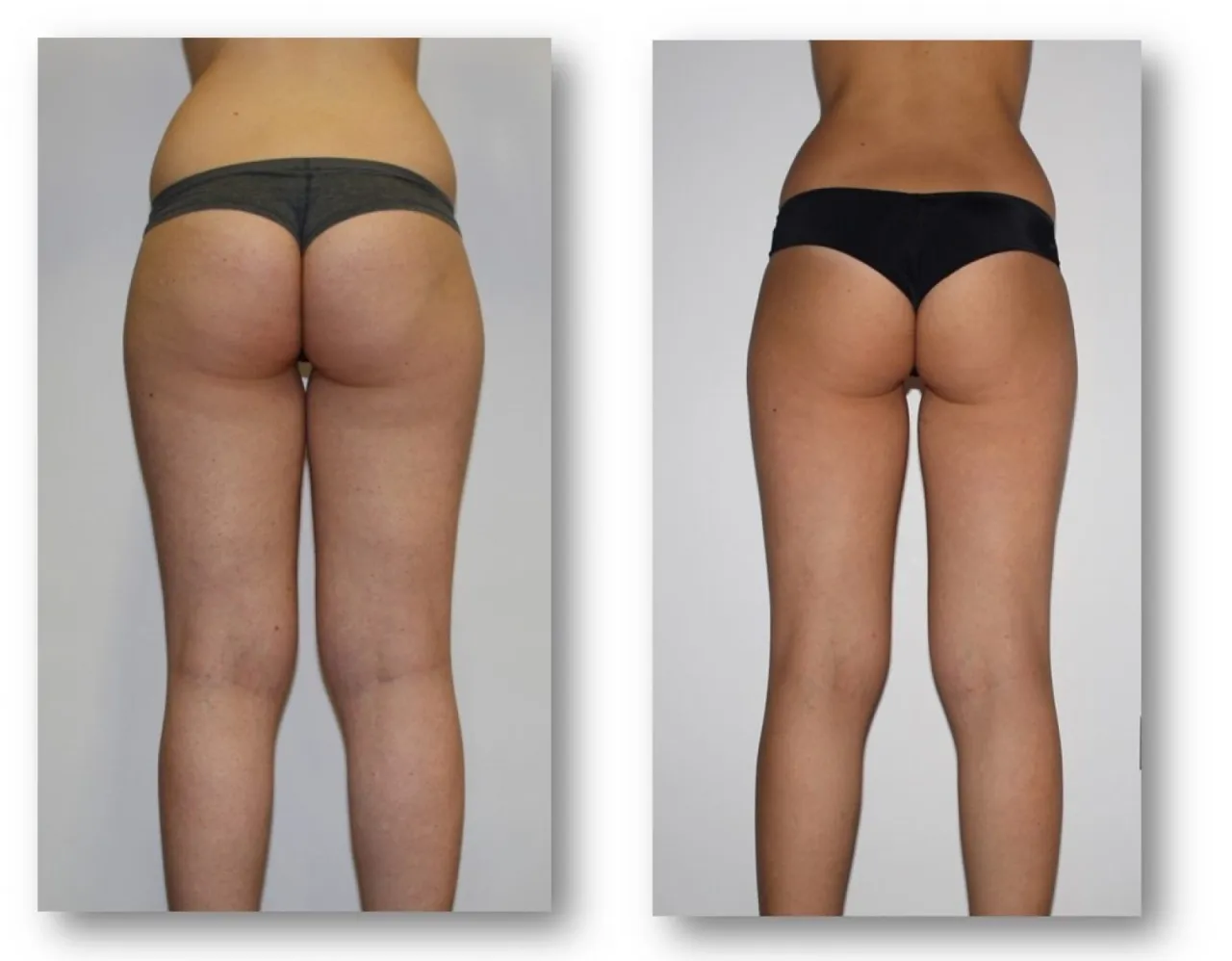 endermologia lpg alliance przed i po