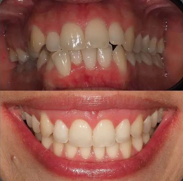 aparat ortodontyczny usta przed po