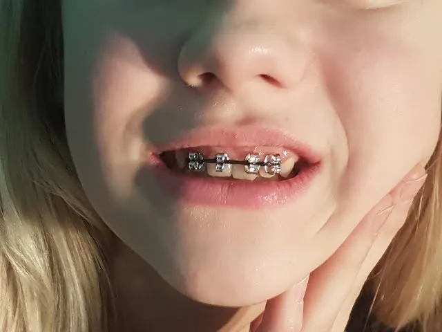 DIY sztuczny aparat na zęby rekwizyt