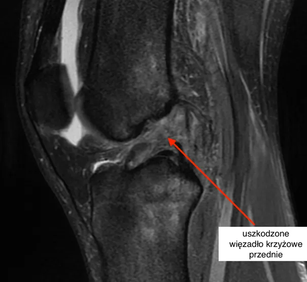 stopnie skręcenia kolana diagram więzadeł