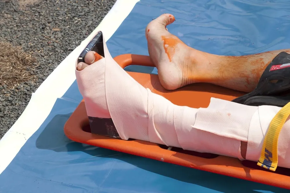 pierwsza pomoc skręcona kostka zasada RICE