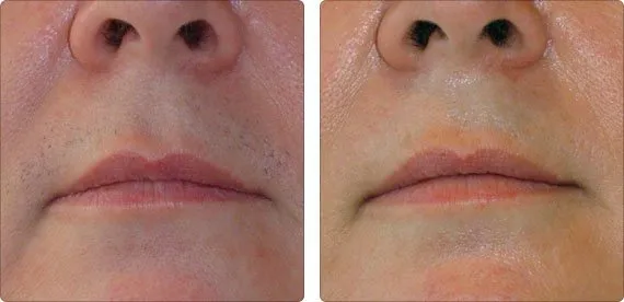 Depilacja laserowa wąsika