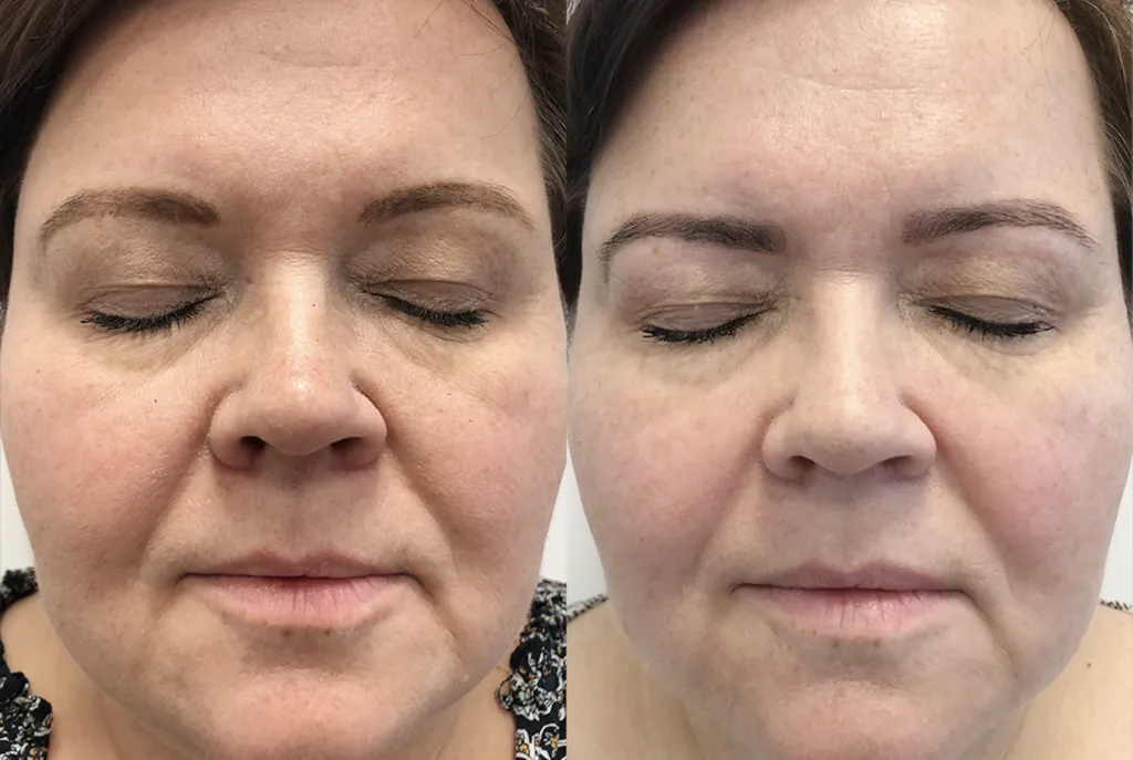 przed i po laser frakcyjny nieablacyjny