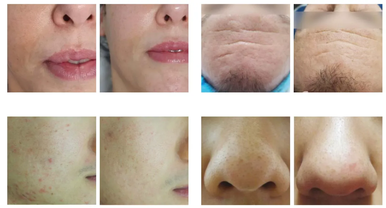 radiofrekwencja mikroigłowa przed i po