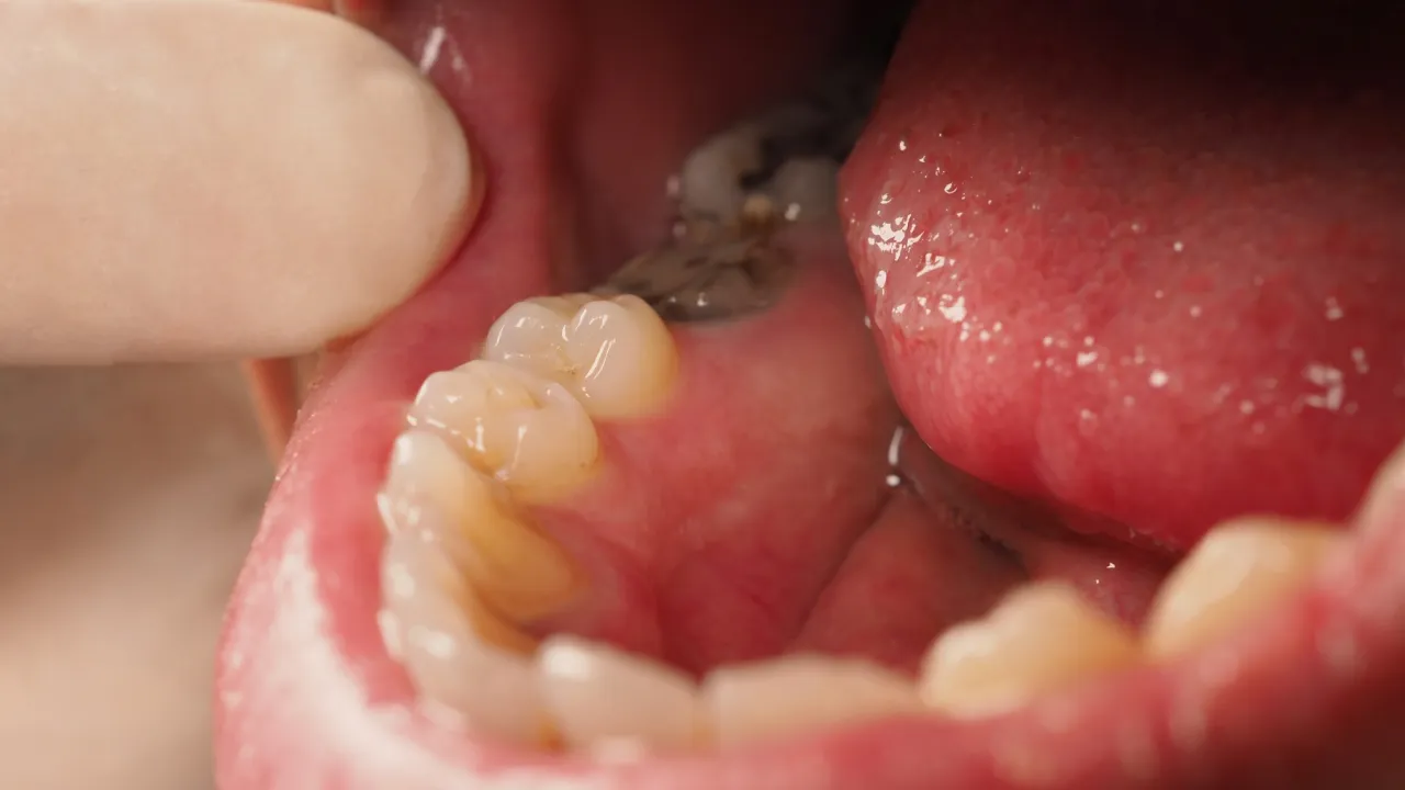 ząb do leczenia kanałowego objawy wizualne, przebarwiony ząb, ropień dziąsła