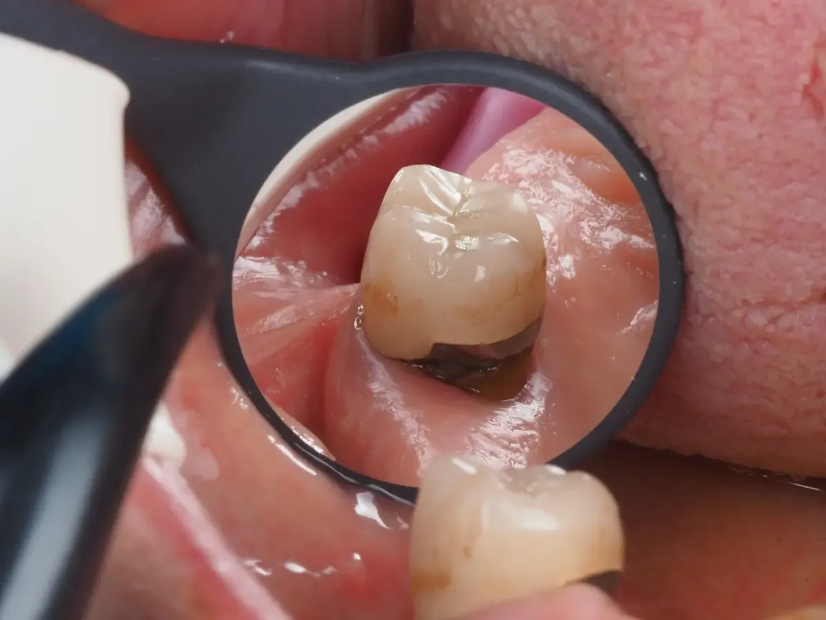 uszkodzona korona zębowa