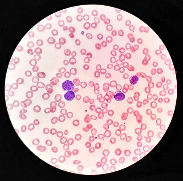 różne wielkości czerwonych krwinek anizocytoza