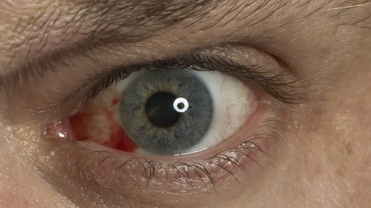 Augen mit Vitamin C Mangel Symptomen