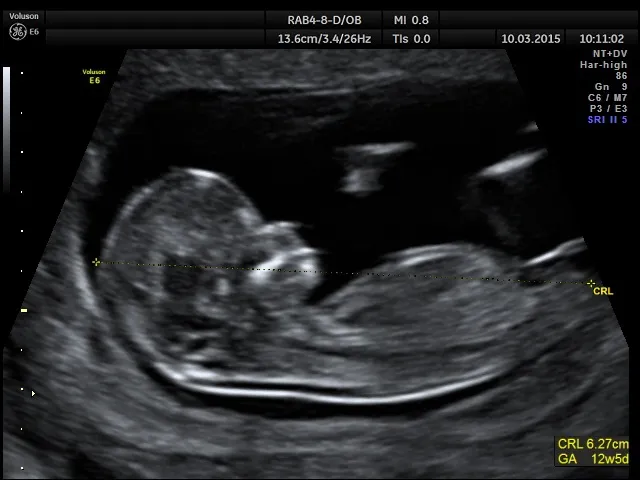 Zdjęcie Ile razy powinny być wykonywane badania prenatalne w ciąży?