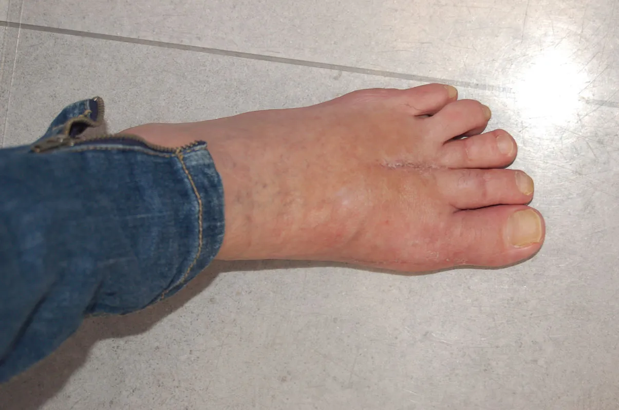 objawy infekcji rany po operacji haluksa