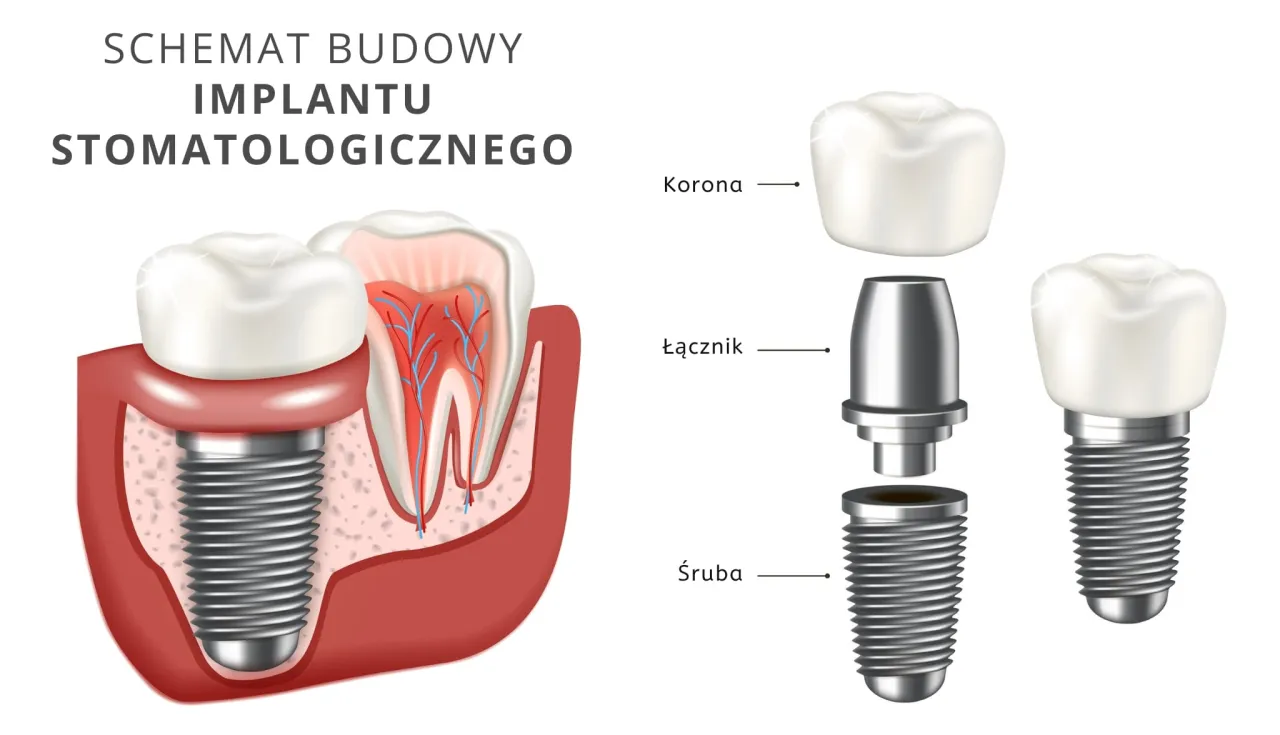 Implant zęba schemat