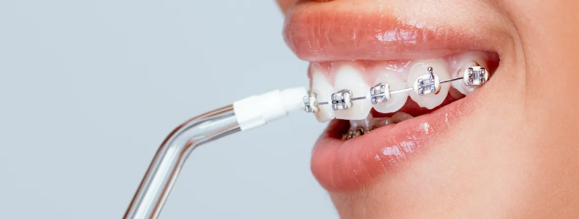 irygator do zęb&oacute;w dla kogo aparat ortodontyczny implanty