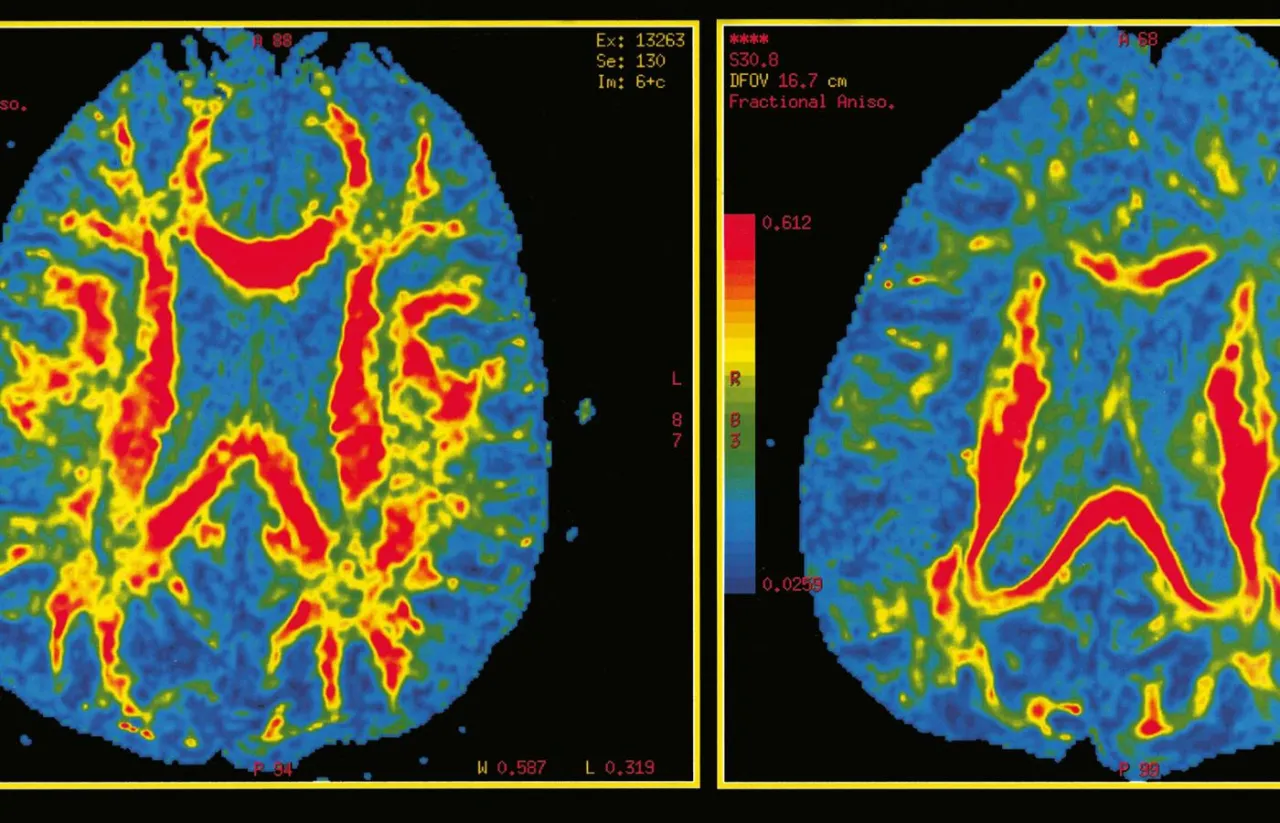 Obraz mózgu w kolorach, pokazujący zmiany mogące wskazywać na alzheimer objawy u młodych.