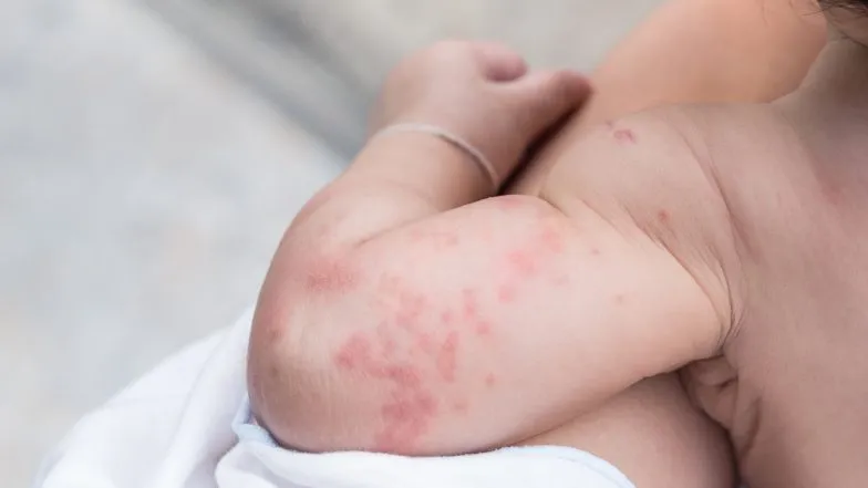 pokrzywka u dziecka objawy