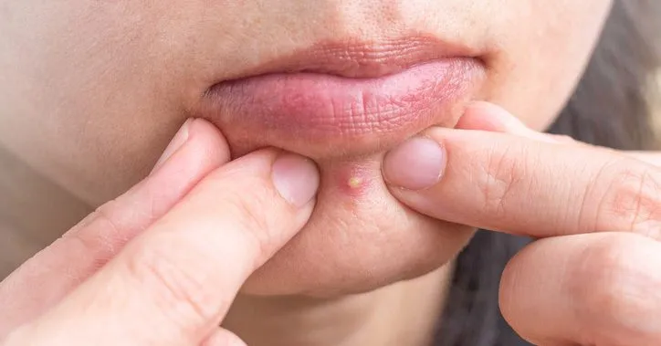 pryszcz podskórny przekrój skóry lub zakaz wyciskania