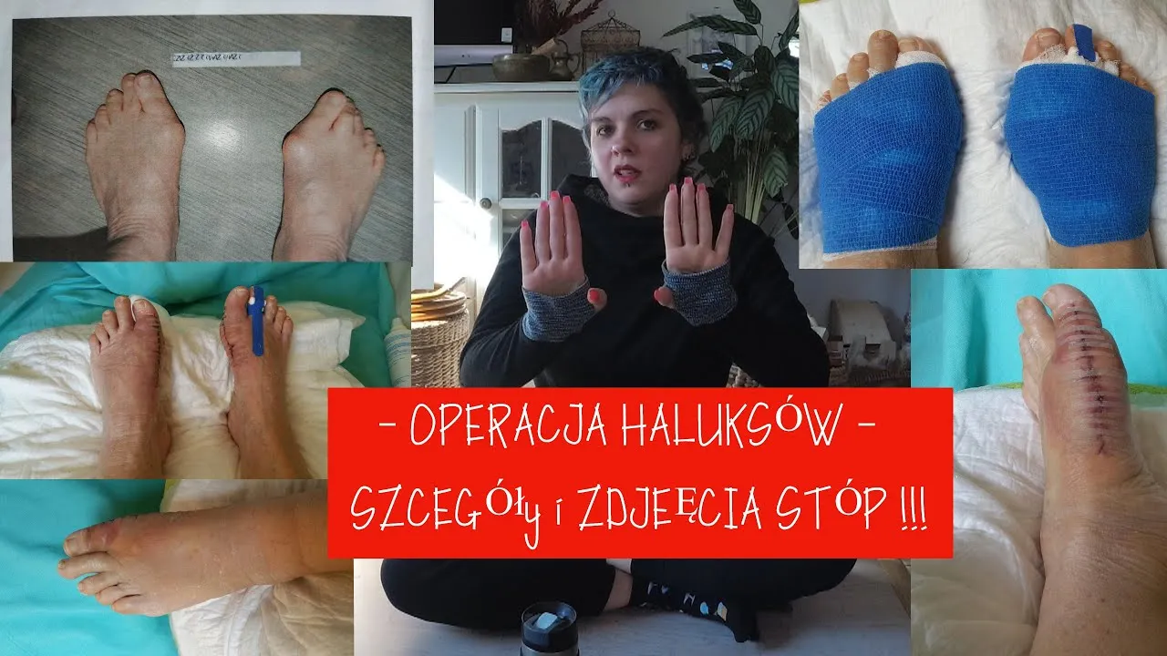 Porównanie kosztów operacji haluksa NFZ a prywatnie