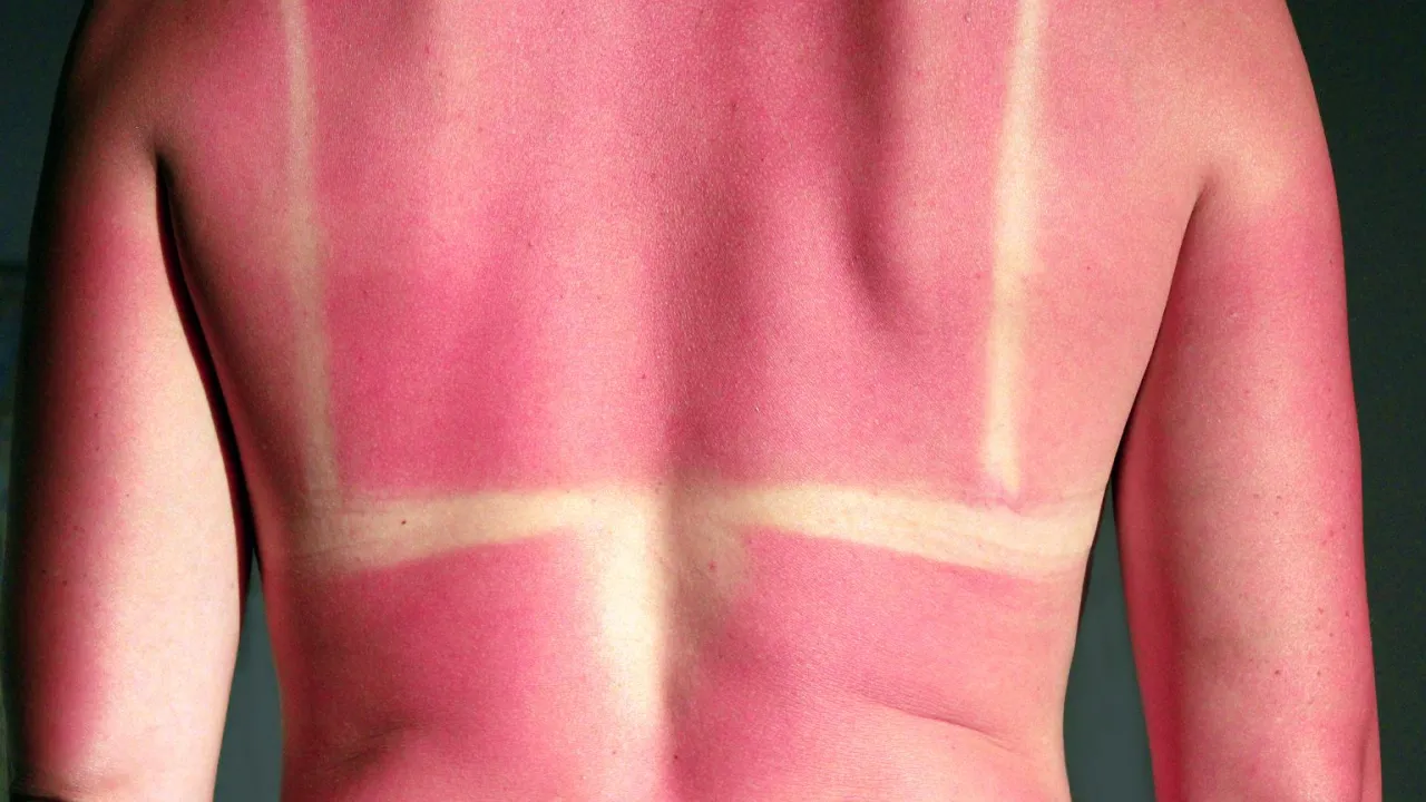 Oparzenie po solarium na plecach, widoczne jasne pasy od stroju kąpielowego na zaczerwienionej sk&oacute;rze.