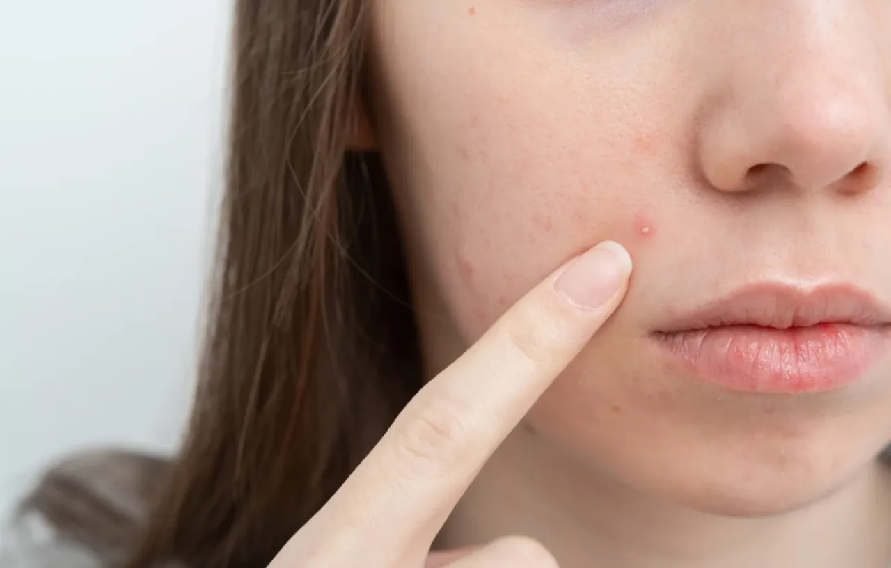 domowe sposoby na pryszcze, naturalne składniki na wypryski