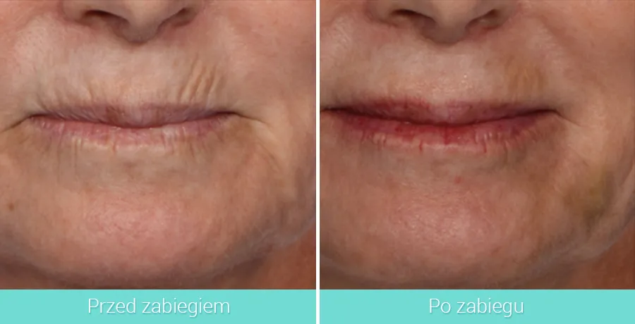 botoks zmarszczki palacza przed i po