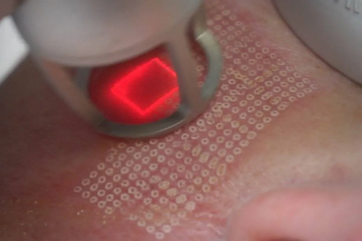 Laser frakcyjny zastosowania problemy sk&oacute;rne