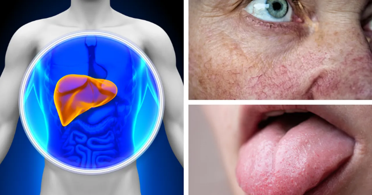 Widok wątroby w ciele, zbliżenie na pajączki na twarzy i język. Objawy b&oacute;lu wątroby mogą być widoczne na sk&oacute;rze i języku.