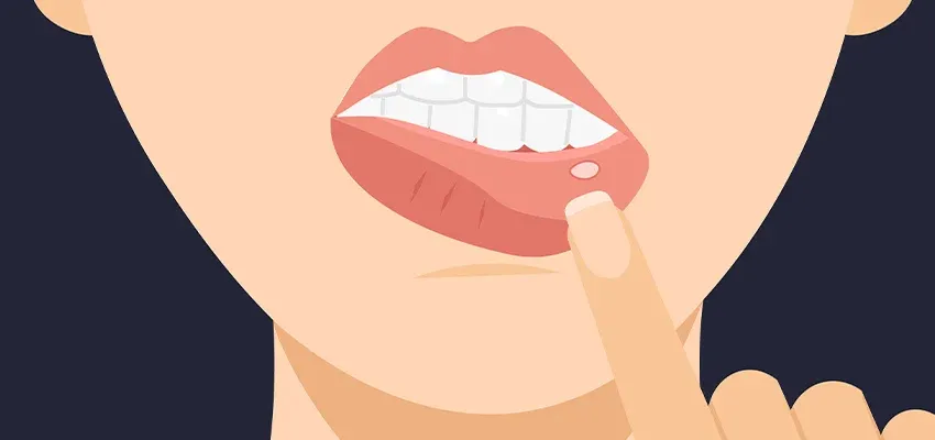 Rodzaje ran w jamie ustnej przyczyny