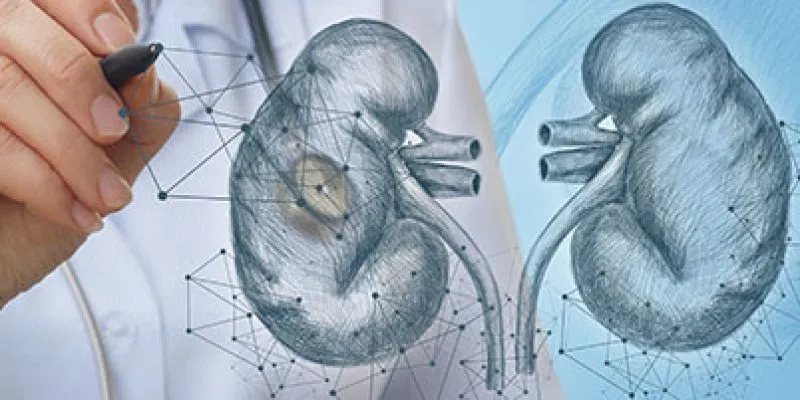 Endourologia laserowe leczenie kamicy nerkowej
