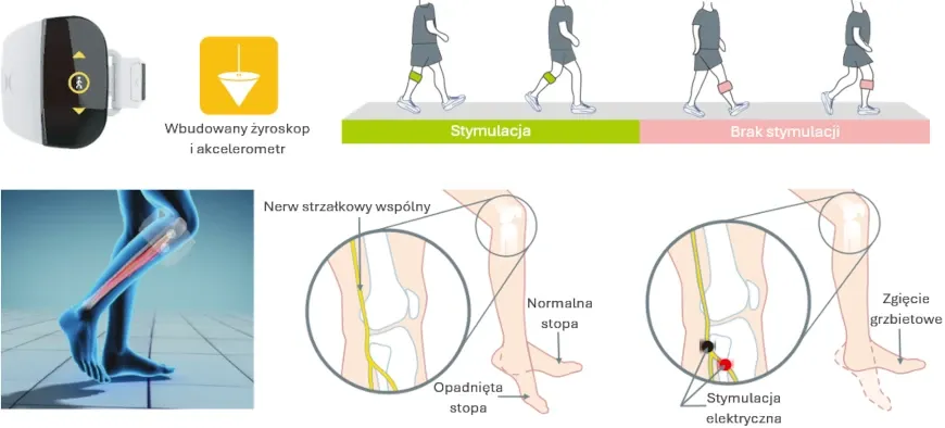 orteza opadająca stopa lub elektrostymulacja FES