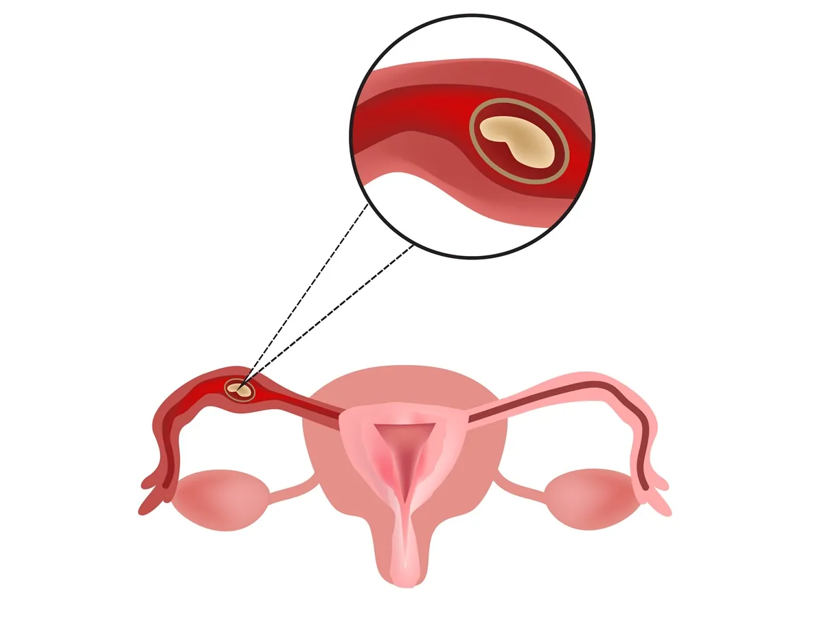 ciąża pozamaciczna schemat lokalizacji