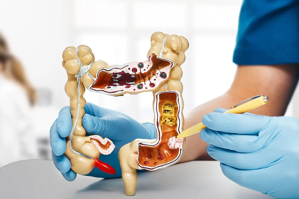 Zdjęcie Czy rak jelita wyjdzie w badaniu krwi? Prawda o diagnozie nowotworu