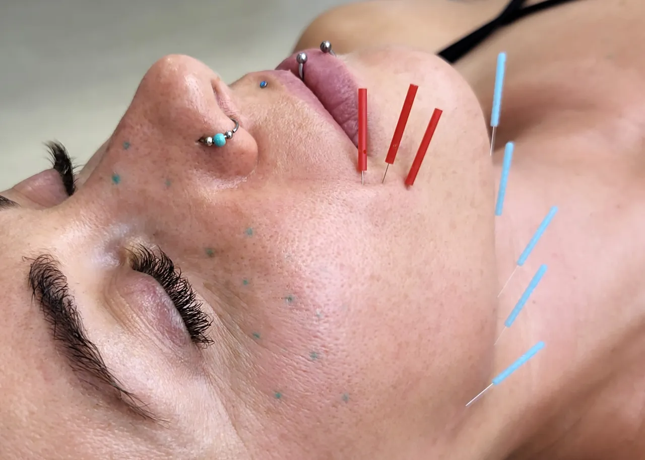 akupunktura na zatoki igły twarz