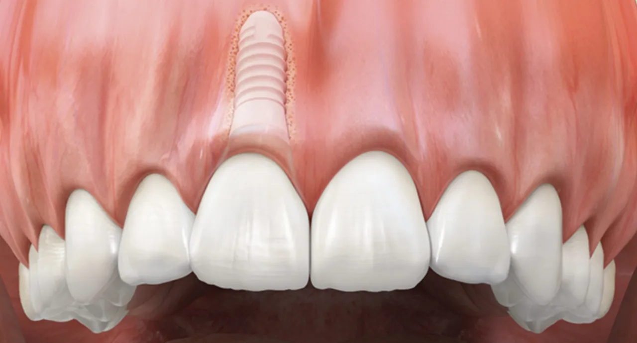 Por&oacute;wnanie implant&oacute;w tytanowych i cyrkonowych