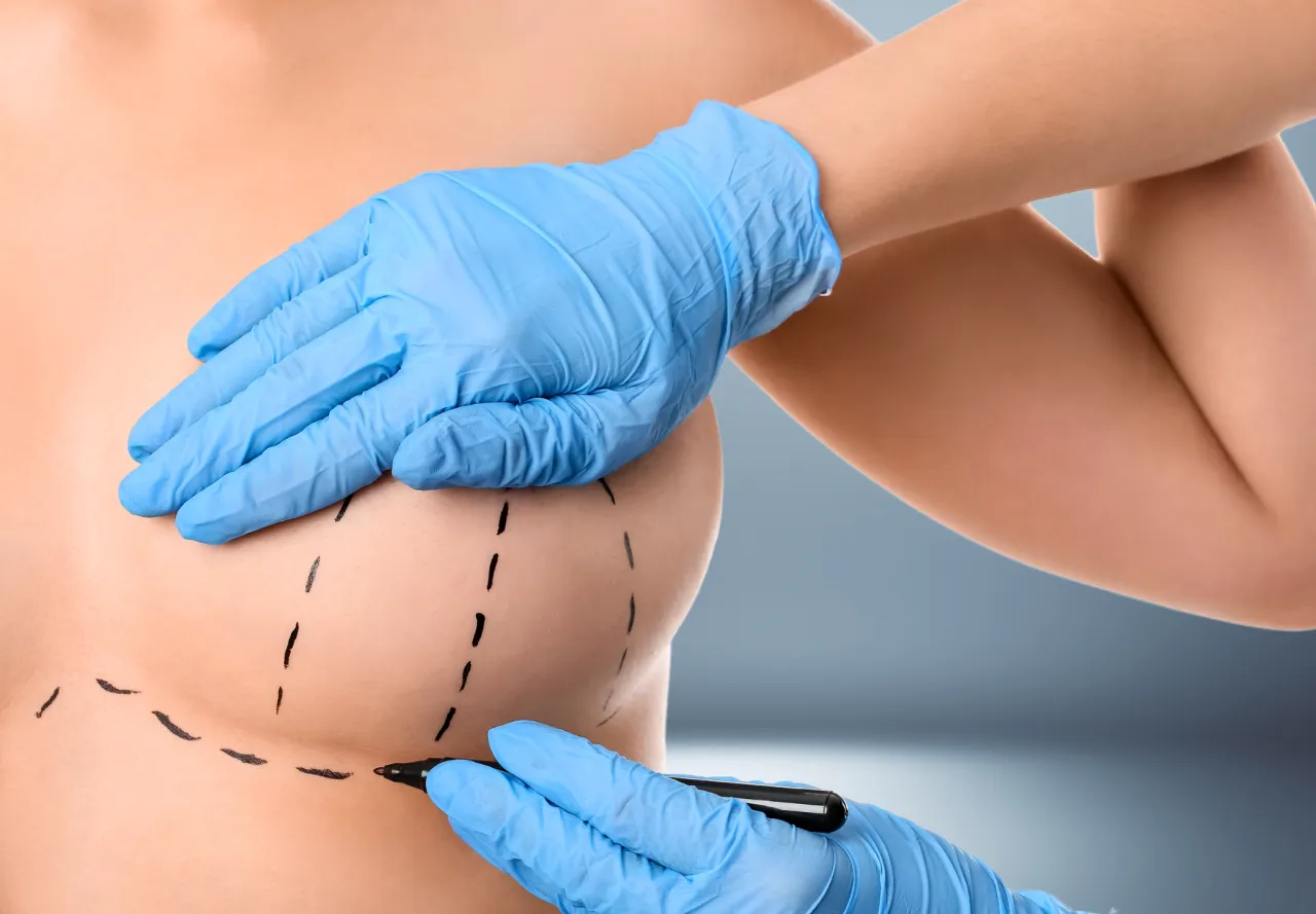 Mastopeksja schemat zabiegu