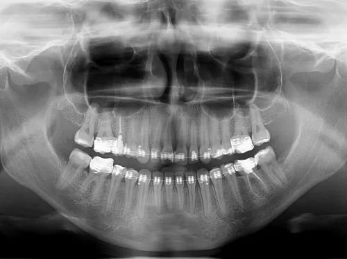 rentgen zęba pantomogram