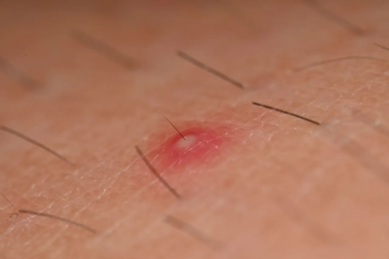 Pryszcze na pośladkach przyczyny