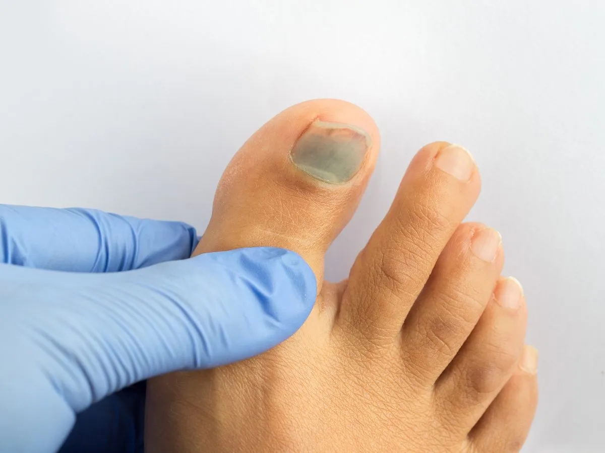 Siny paznokieć u nogi - pierwsza pomoc