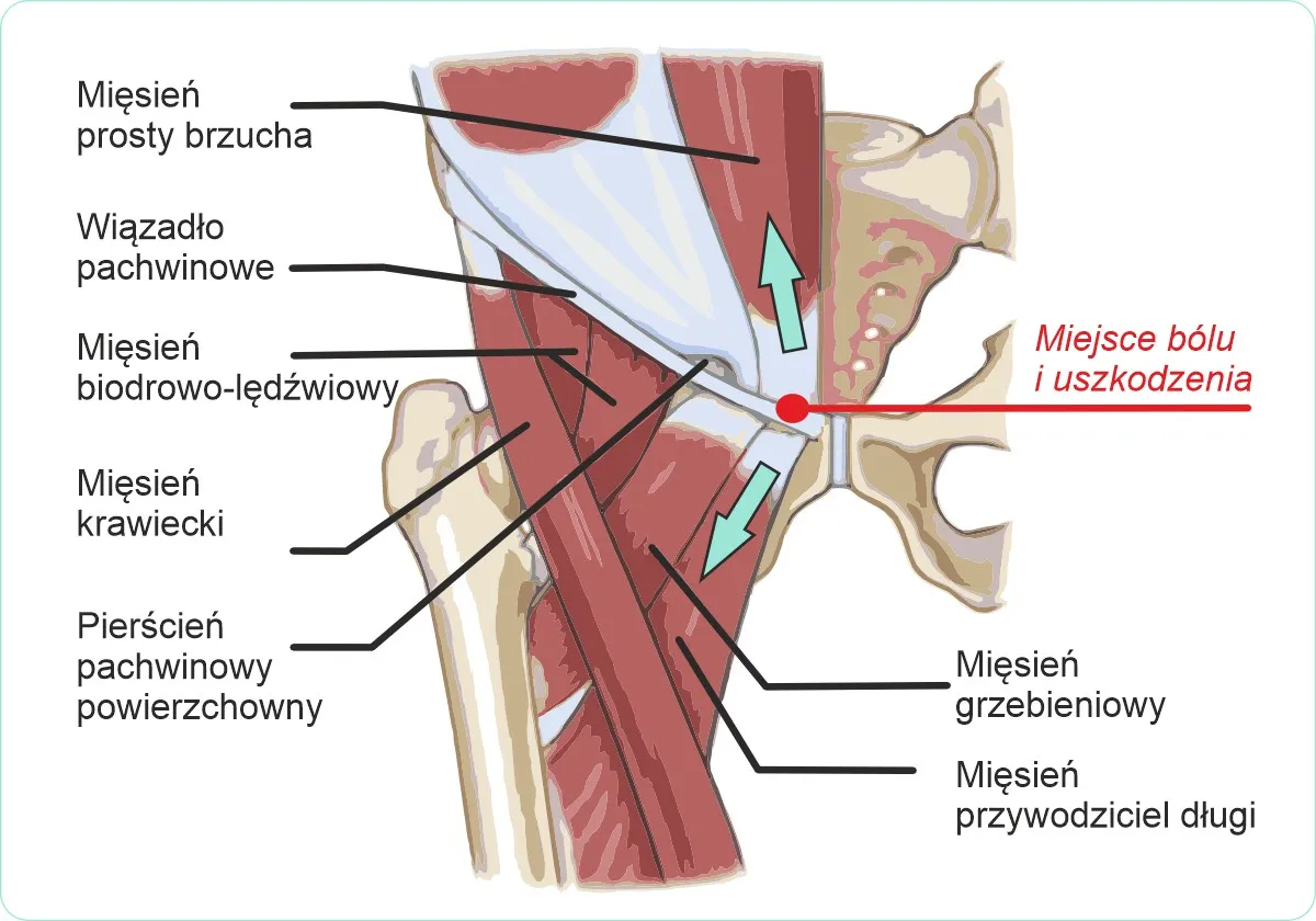 anatomia mięśni pachwiny, przyczyny bólu pachwin