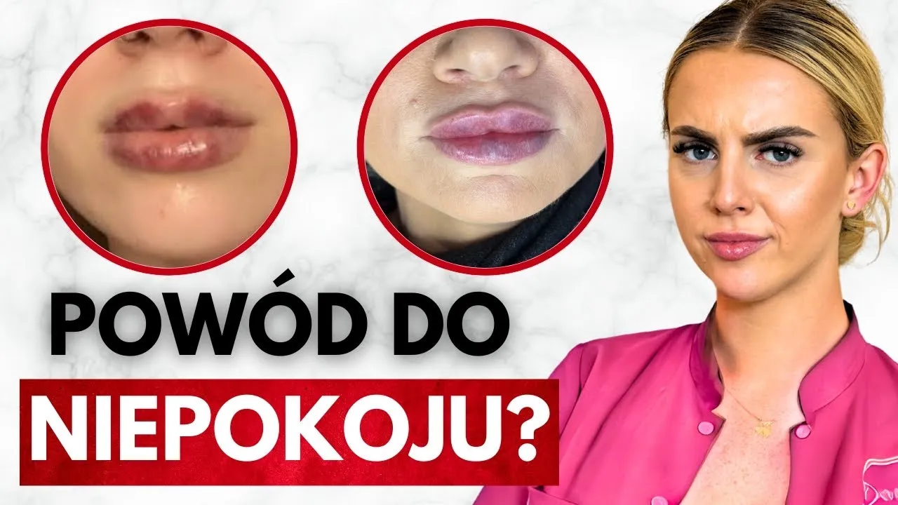 usta po powiększaniu obrzęk i siniaki