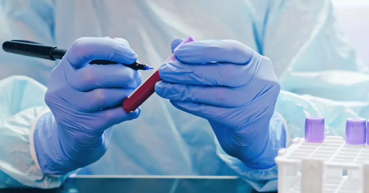 Zdjęcie Podwyższona ferrytyna? Zaskakujące przyczyny, o których nie wiesz