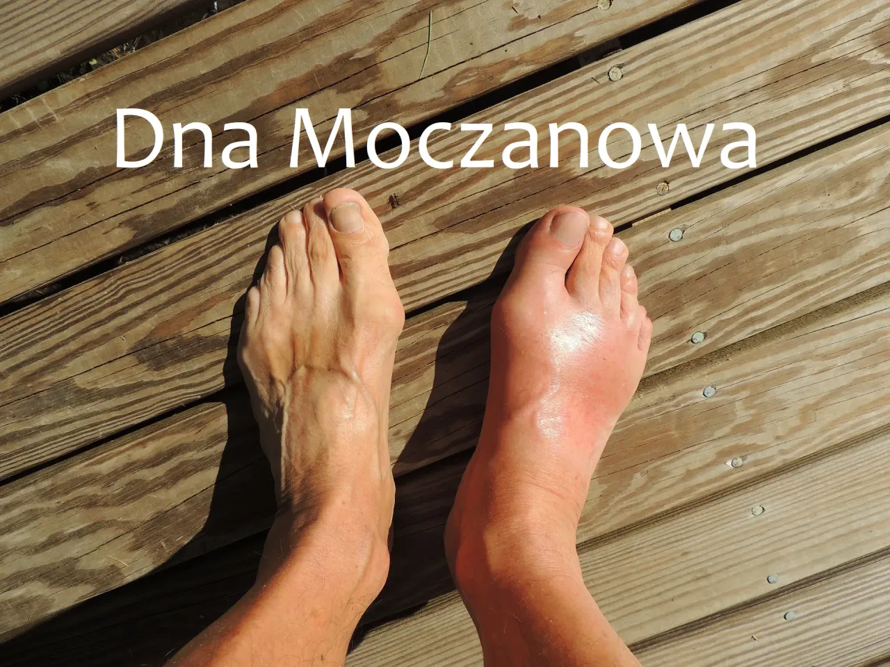 Dna moczanowa przyczyny infografika