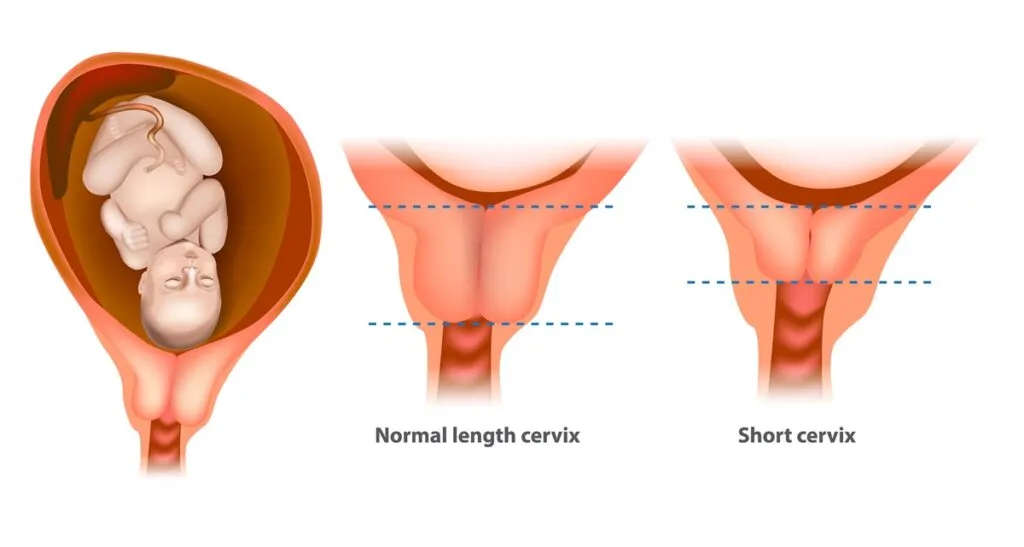 prawidłowa i skrócona szyjka macicy w ciąży schemat