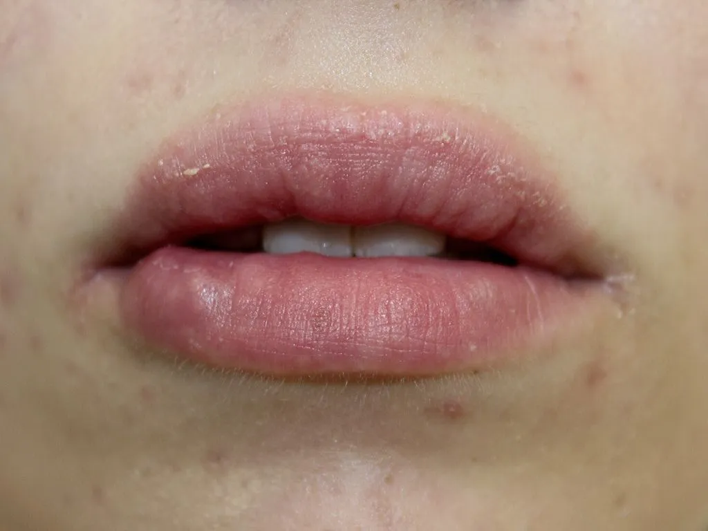 Obrzęk ust po powiększaniu, zimny okład na usta