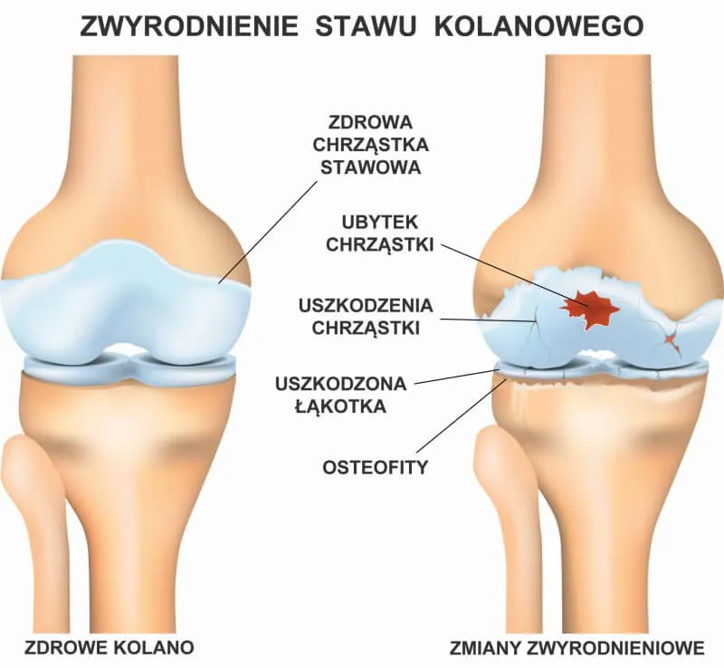 Choroba zwyrodnieniowa stawu kolanowego schemat